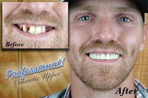 Vista 2 de Professional Cosmetic Upper - New from Instant Smile! Hand Crafted Detail, Custom fit at Home! Works Best in Medium to Large Sized Mouths.