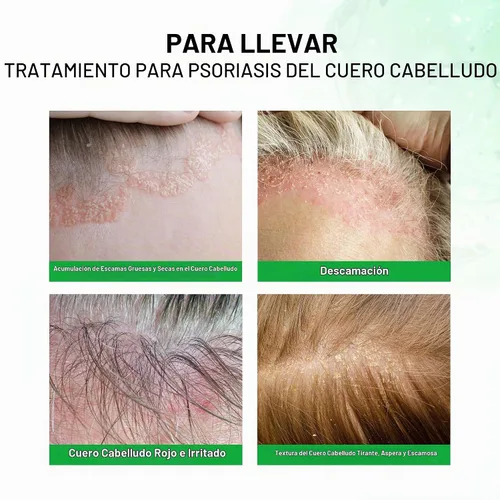 Vista 5 de RoyceDerm Spray de tratamiento de la psoriasis del cuero cabelludo