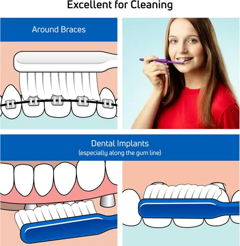 Vista 3 de TePe Cepillo de dientes suave de ortodoncia para implantes – Cabeza de cepillo extra estrecha cuello delgado 1Pk