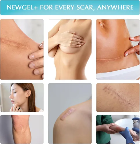 Vista 8 de NewGel+E Gel avanzado de silicona para tratamiento de cicatrices para cicatrices viejas y nuevas con vitamina E, para cirugía, lesiones, queloides