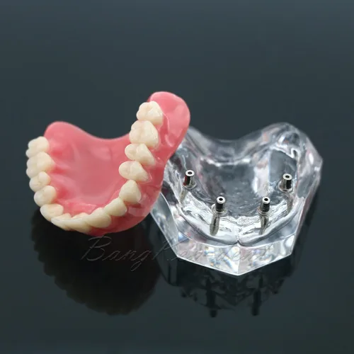 Vista 7 de Dental Implante Typodont Restauración Dientes Modelo M6001 Sobredentadura clara 4 implantes Superior Superior Demo para Estudio Enseñar