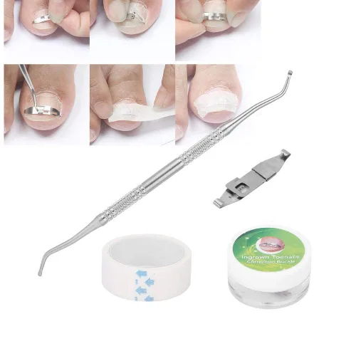 Kit de eliminación de uñas encarnadas de 3 piezas, herramienta profesional de acero inoxidable para uñas encarnadas, diseño elástico, tratamiento de