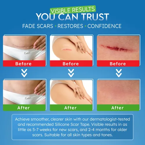 Vista 6 de Hojas reutilizables de silicona de grado médico (rollo de 1.6 x 59 pulgadas, 4.9 ft), cinta de cicatriz para cicatrices quirúrgicas, cinta