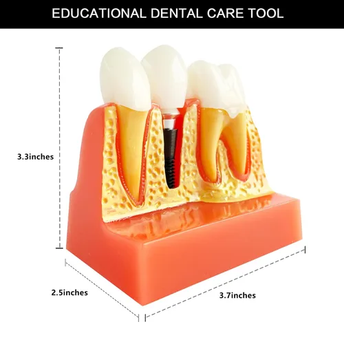 Vista 2 de Modelo de implante dental con puente de corona extraíble, modelo de dientes demostrativos ampliados 4 veces para educación y estudio, ideal