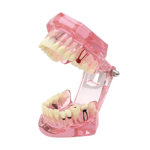 Vista 6 de Dientes Modelo Dientes Typodonts Dental Implante Estudio Análisis Demostración Dientes Modelo #2001 con Restauración Rosa