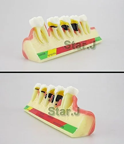 Vista 3 de Dental Periodontal Disease assort Dientes Dientes Typodont Estudio Modelo de Enseñanza Nuevo