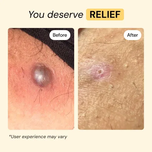 Vista 3 de MyMagicHealer Universal Flare Care Pomada Extractora para HS, forúnculos, quistes, hemorroides, quiste pilonidal, absceso Anti-rozaduras