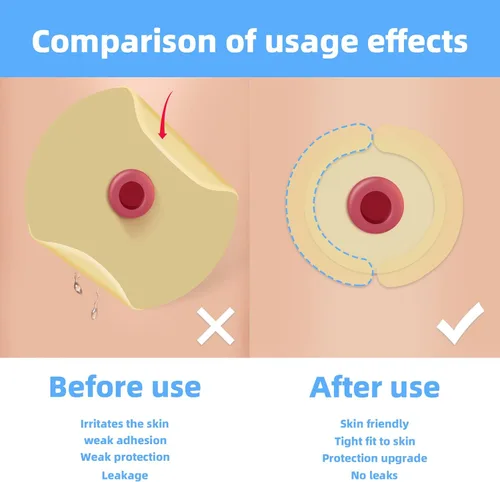 Vista 3 de Suministros de ostomía, tiras de barrera de ostomía, tiras elásticas de barrera para bolsas de colostomía, hidrocoloide de grado médico