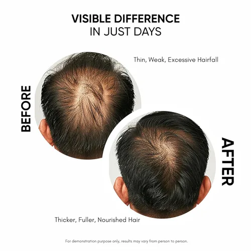 Vista 3 de Masofta Suero para el crecimiento del cabello para densidad, control de caída del cabello con 3% Redensyl, 5% Capixyl, 4% Anagain, 3% Procapil y 3%