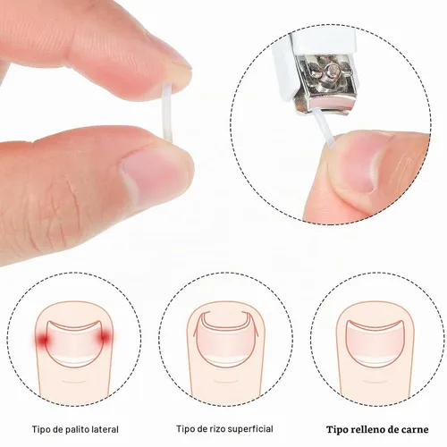 Vista 4 de 60 tiras correctoras de uñas encarnadas, corrección de uñas encarnadas, corrección de uñas, clip para enderezar uñas, parche curvo corrector de uñas
