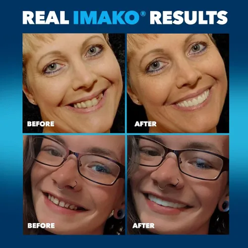 Vista 6 de Imako Cosméticos Premium para Parte Superior - Paquete de 2 - Pequeño, Blanco Blanqueado - Transformación de Sonrisa Hazlo Tú Mismo - Hecho en EE.UU