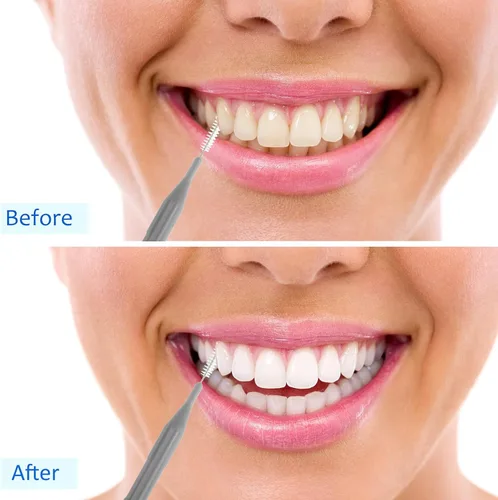 Vista 7 de Patelai Juego de 100 cepillos interdentales, púas limpiadoras suaves con tapa, herramienta de limpieza de huecos de dientes de varios tamaños