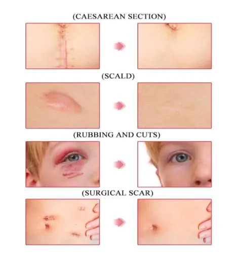 Vista 2 de Crema Para Cicatrices elimina las cicatrices de cara cuerpo cuida tu piel
