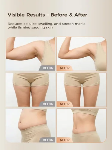 Vista 5 de Masajeador de drenaje linfático y herramienta de masaje anticelulitis, para piernas, brazos y vientre, cuerpo, ayuda a reducir las estrías