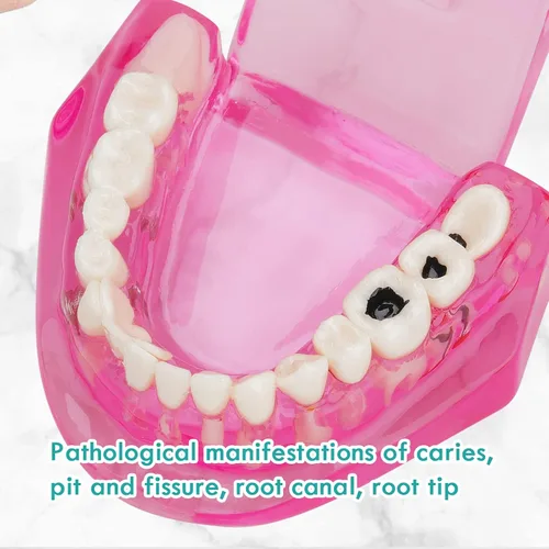 Vista 6 de Modelo de dientes de implante dental transparente - Modelo de dientes de enfermedad transparente Modelo de dientes patológicos con dientes