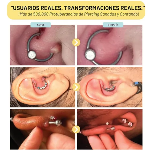 Vista 5 de BASE LABORATORIES Gel Eliminador de Protuberancias Queloides Tratamiento Natural para Protuberancias de Piercing y Gel para Cicatrices Queloides