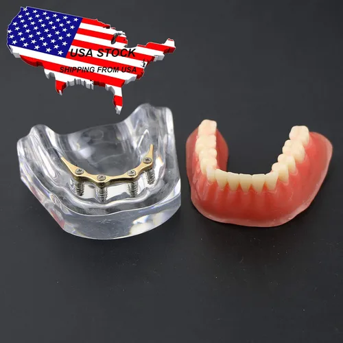 Vista 5 de Dental Dientes Modelo Oro Plata Demostración Color Practise Enseñanza Demo 4 Implante (GOLD BAR)