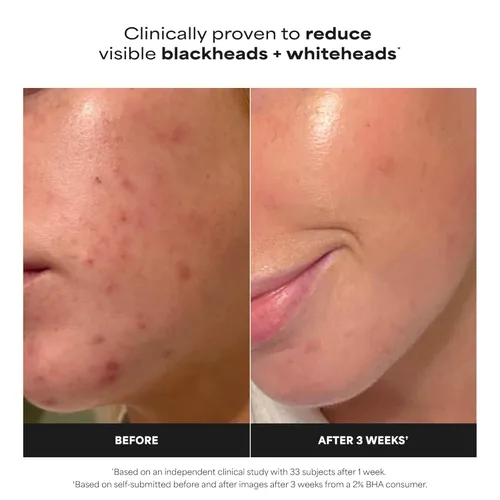 Vista 3 de Paula's Choice Skin Perfecting - Exfoliante líquido de ácido salicílico BHA al 2 %