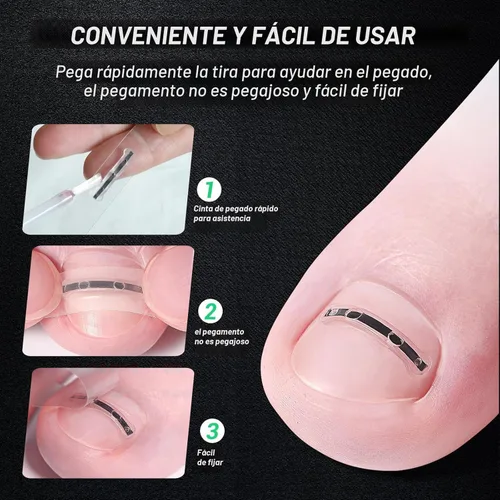 Vista 3 de Tratamiento de uñas encarnadas de aleación de titanio, herramientas de uñas y kit de eliminación de uñas encarnadas especialmente diseñado